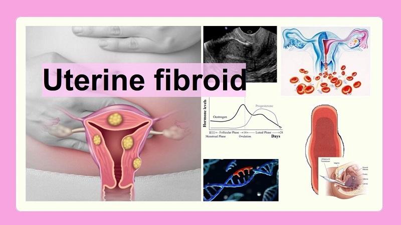 Uterine Fibroid